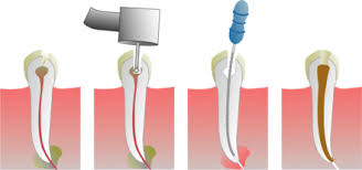 ODONTOLOGIE CONSERVATRICE ENDODONTIE